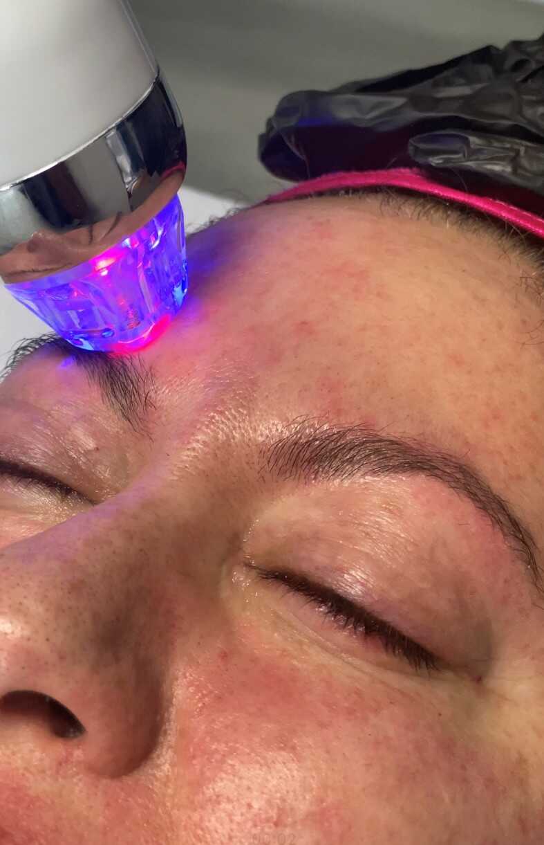 Microneedling Example